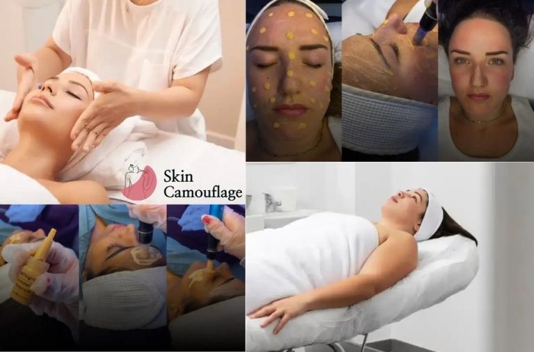 Camouflage Options for White Stretch Marks in Dubai
